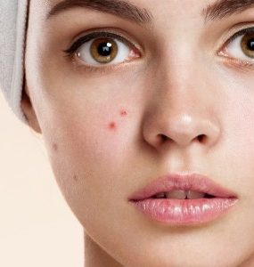 skin purging